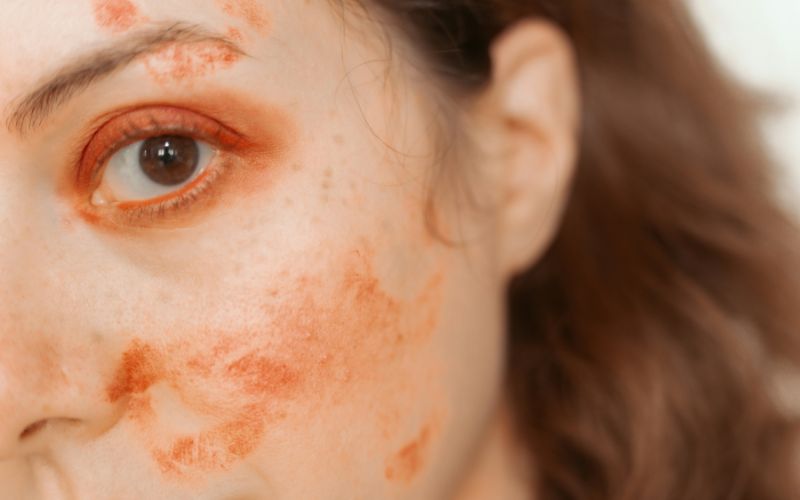 how-to-get-rid-of-sunburn-redness-overnight-main-ways