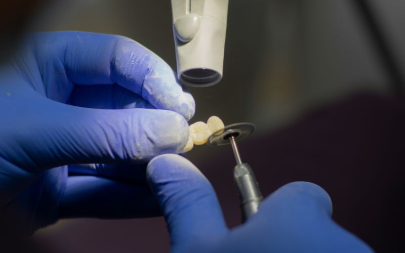 how-much-do-veneers-cost-tips